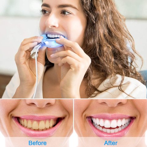 blanqueamiento dental casero