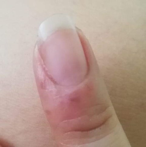 alergia unas acrilicas 1