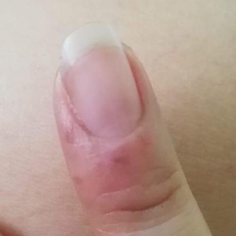 alergia unas acrilicas 1