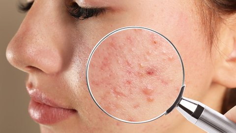cremas acne