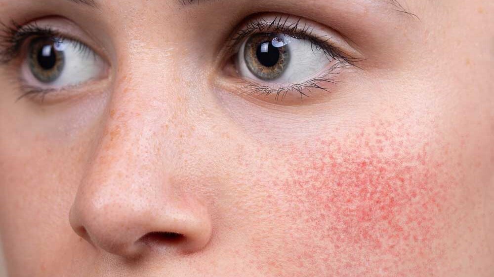 rosacea