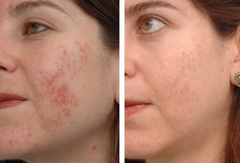 fotofacial 2