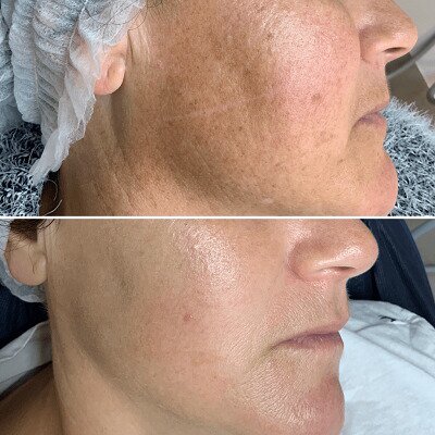 fotofacial 3