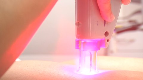 tipo de laser ipl depilacion