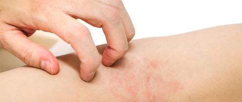caspa dermatitis