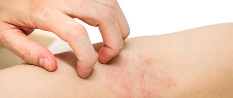 caspa dermatitis