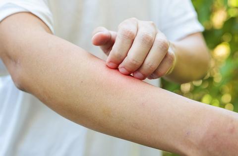 dermatitis atopica