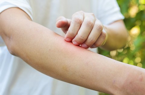 dermatitis atopica