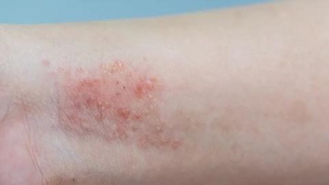 dermatitis vs caspa
