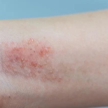 dermatitis vs caspa