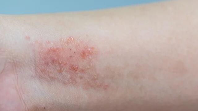 dermatitis vs caspa
