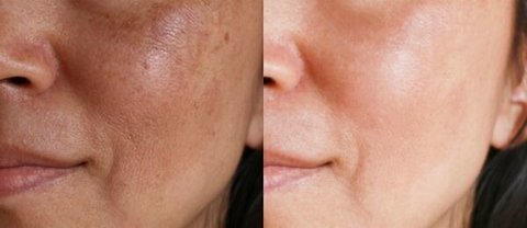 retinol tretinoina