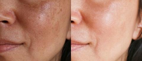 retinol tretinoina