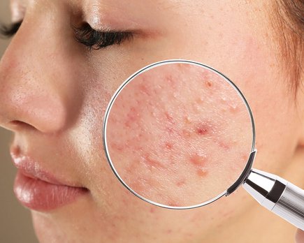 mapa facial ¿ qué significan tus granitos dependiendo de dónde están?