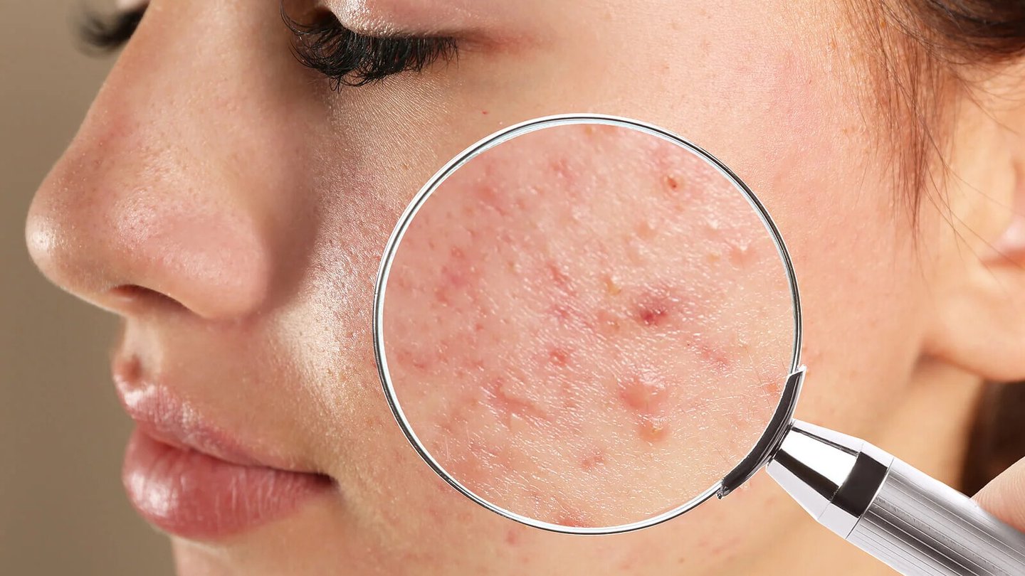 mapa facial acne