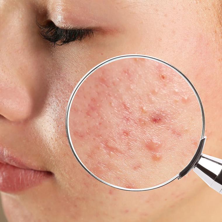 mapa facial acne