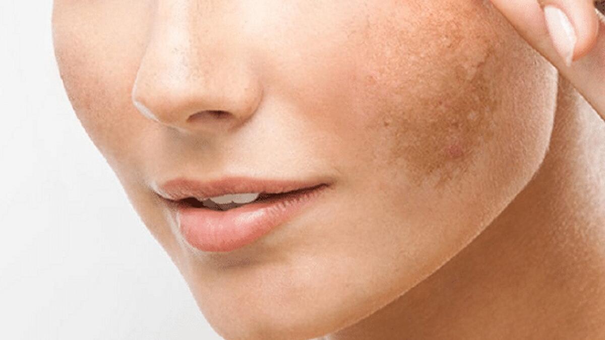 cremas despigmentantes