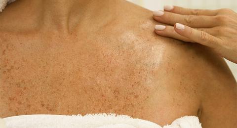 pecas o manchas sol 1