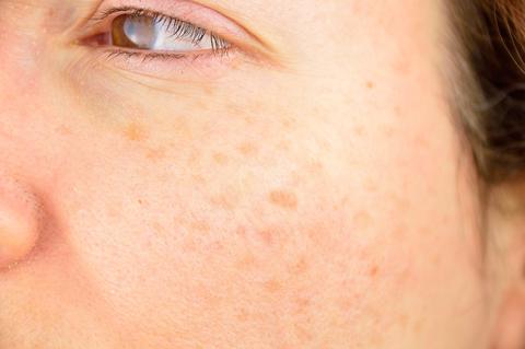 pecas o manchas sol 2