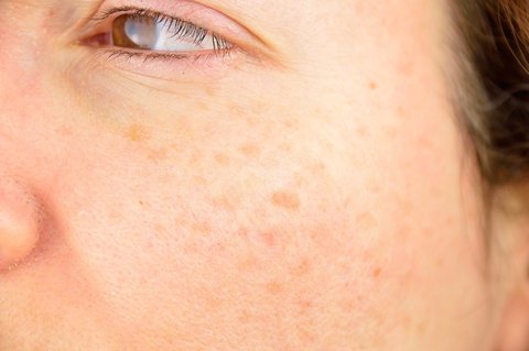 pecas o manchas sol 2