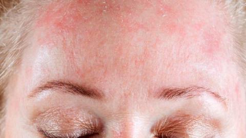 las 7 mejores cremas para la dermatitis atópica en adultos