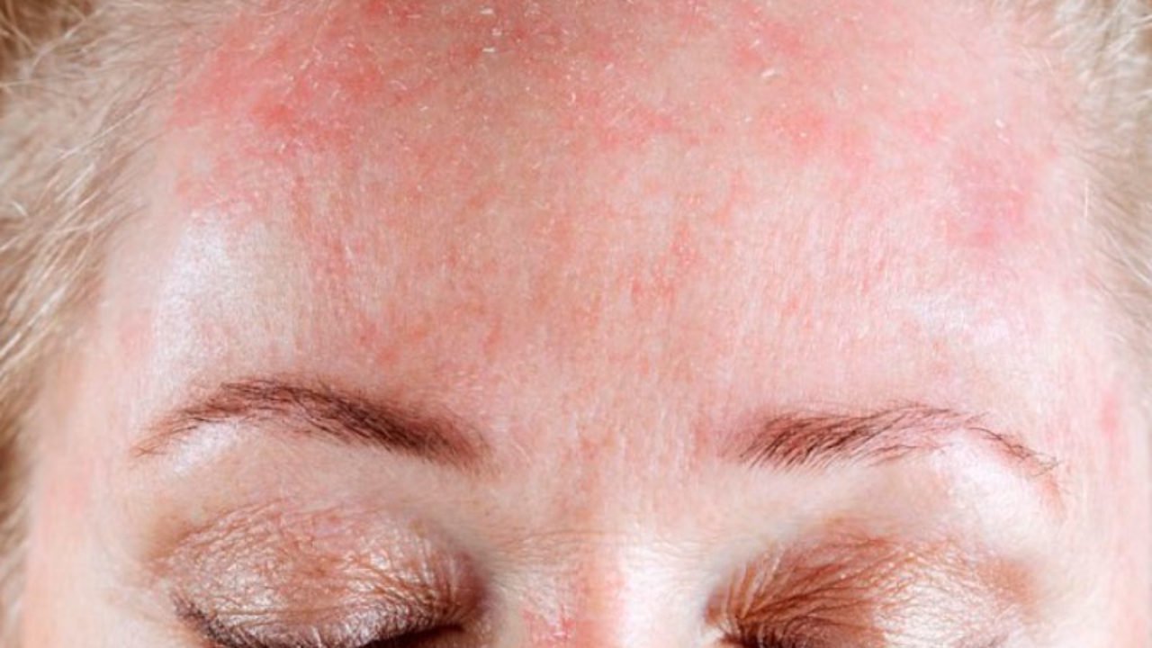 dermatitis