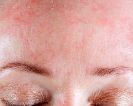 dermatitis