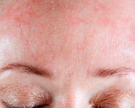 dermatitis