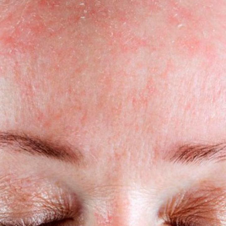 dermatitis
