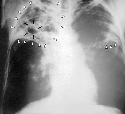 radiografia pulmones tuberculosis