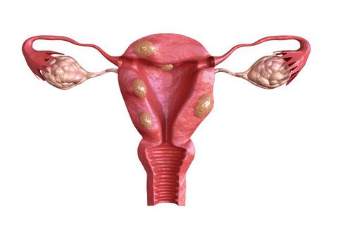 fibromas 1