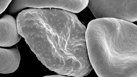 globulo rojo con malaria