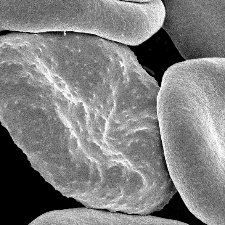 globulo rojo con malaria