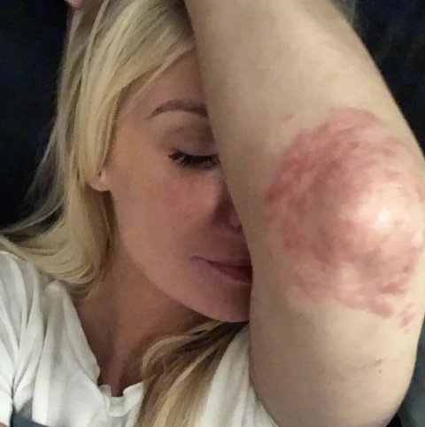 psoriasis imagen