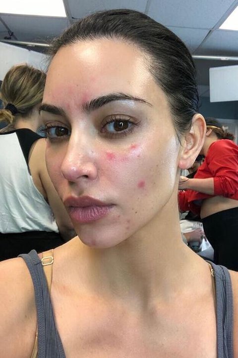 psoriasis kim