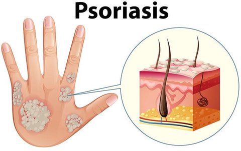 psoriasis